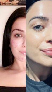 acne-before-and-after