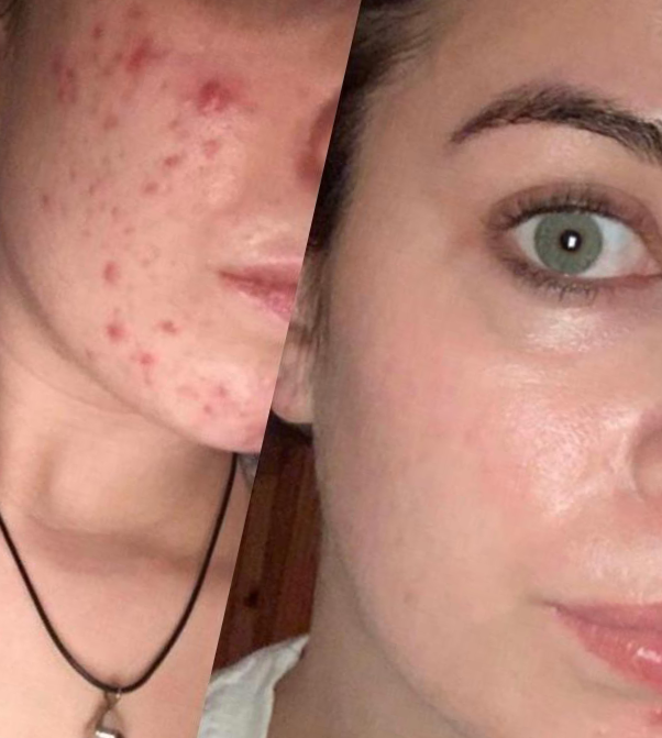 VitaminBeth acne before and after