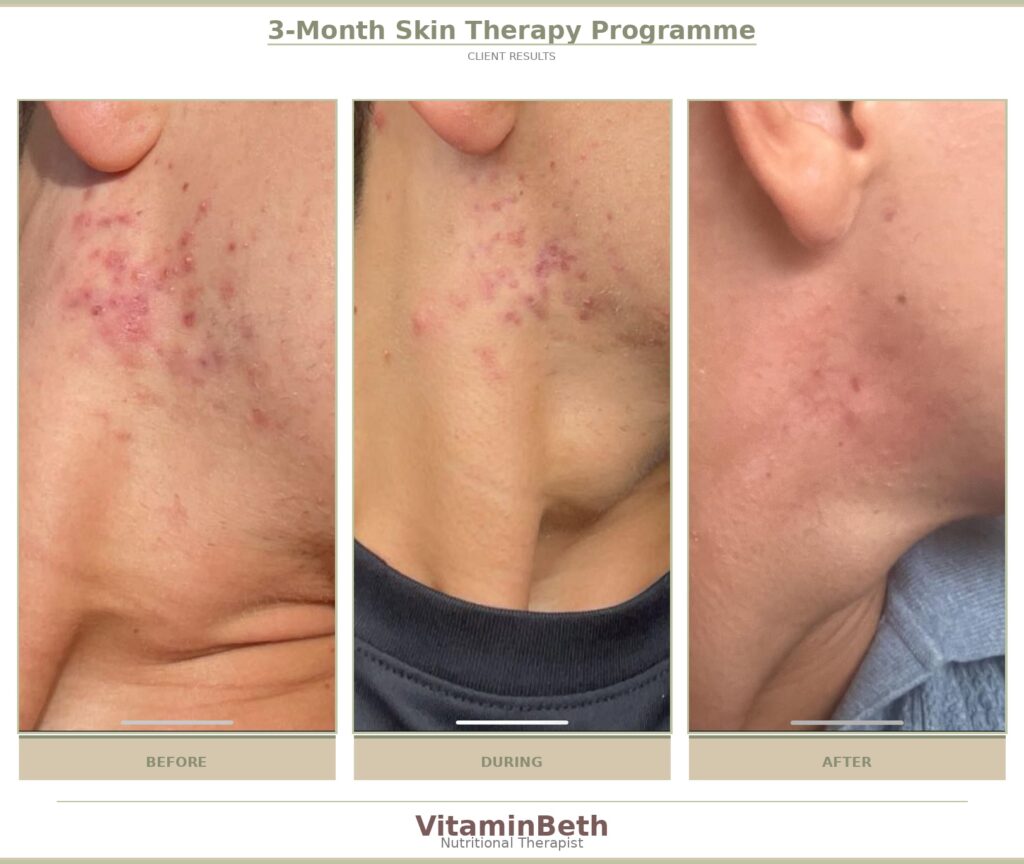 Acne 3-month skin therapy results showing improvement in jawline and neck acne
